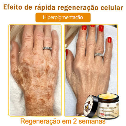 🔥 𝑻𝑳𝑶𝑷𝑨® Creme de Tratamento da Pele com Veneno de Abelha (👨‍⚕️ Com Certificação CE) 👍✅