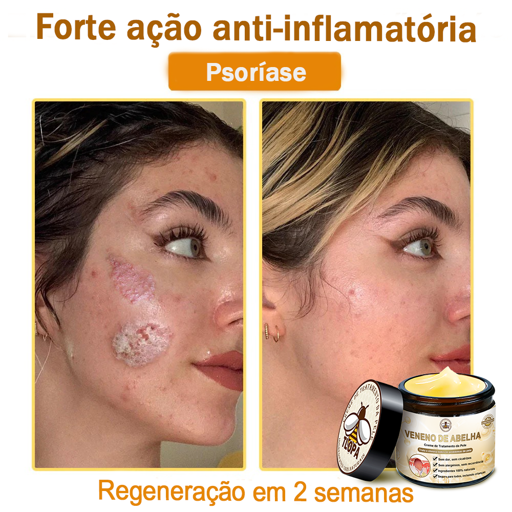 🔥 𝑻𝑳𝑶𝑷𝑨® Creme de Tratamento da Pele com Veneno de Abelha (👨‍⚕️ Com Certificação CE) 👍✅