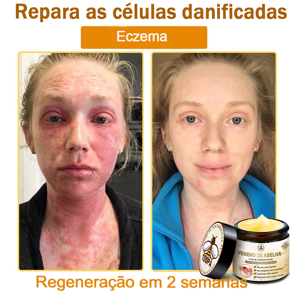 🔥 𝑻𝑳𝑶𝑷𝑨® Creme de Tratamento da Pele com Veneno de Abelha (👨‍⚕️ Com Certificação CE) 👍✅