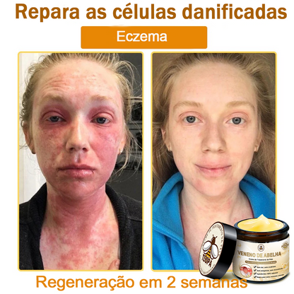 🔥 𝑻𝑳𝑶𝑷𝑨® Creme de Tratamento da Pele com Veneno de Abelha (👨‍⚕️ Com Certificação CE) 👍✅