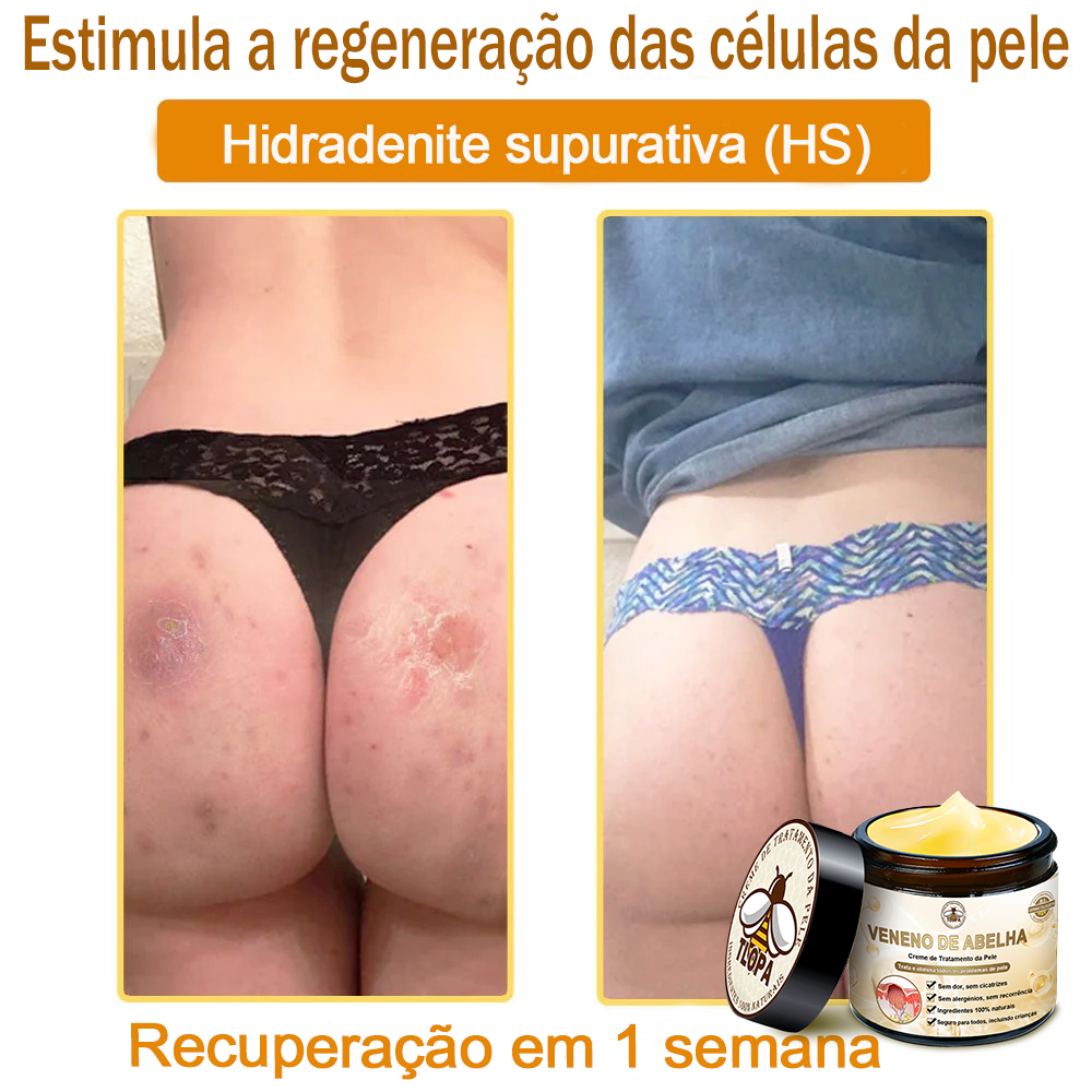 🔥 𝑻𝑳𝑶𝑷𝑨® Creme de Tratamento da Pele com Veneno de Abelha (👨‍⚕️ Com Certificação CE) 👍✅