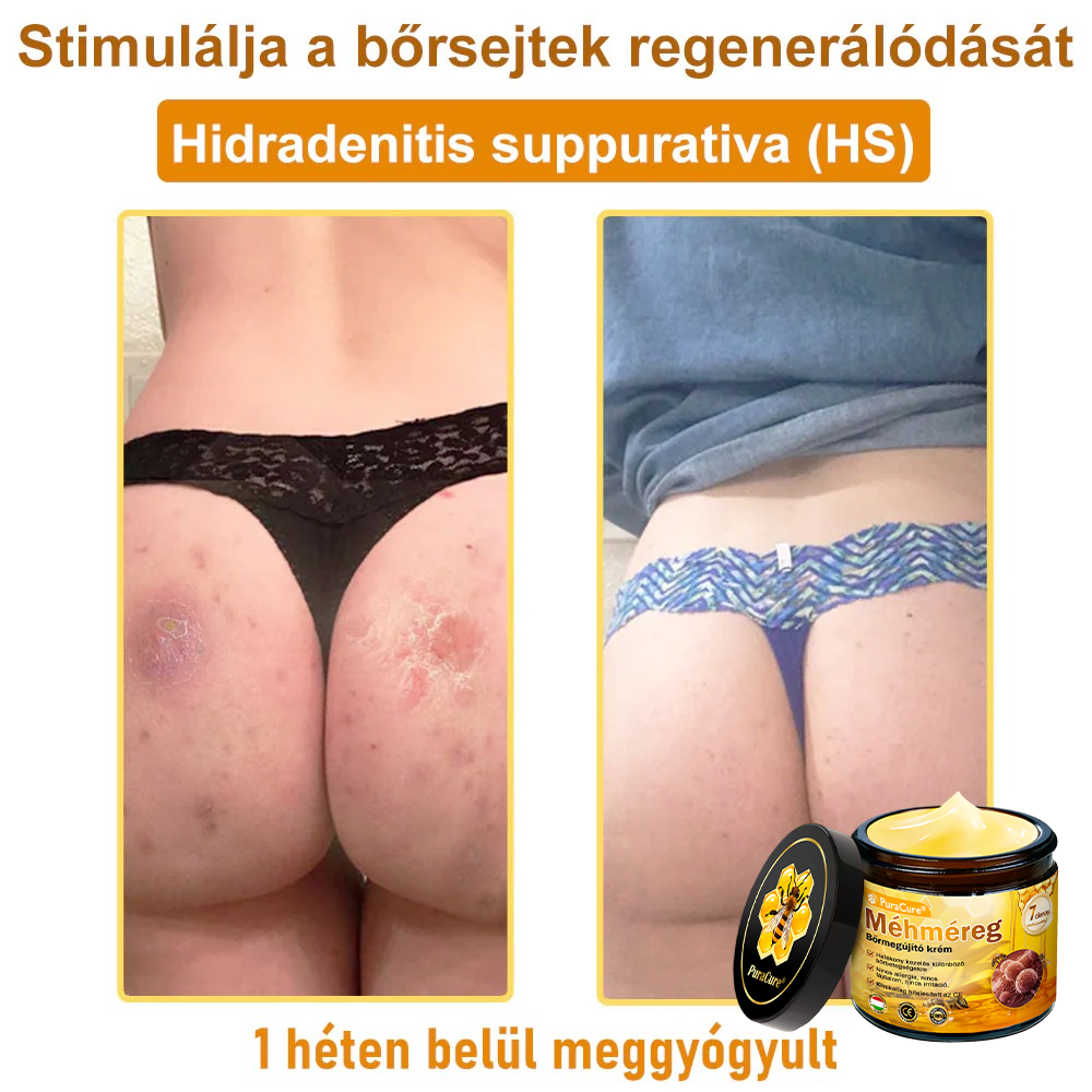 ✨✨ 𝐏𝐮𝐫𝐚𝐂𝐮𝐫𝐞® 𝐌é𝐡𝐦é𝐫𝐞𝐠 𝐁ő𝐫 𝐇𝐞𝐥𝐲𝐫𝐞á𝐥𝐥í𝐭ó 𝐊𝐫é𝐦 (👨‍⚕‍𝐂𝐄 𝐓𝐚𝐧ú𝐬í𝐭𝐯á𝐧𝐲)👍✅